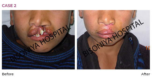 Cleft Lip Surgery - Case2